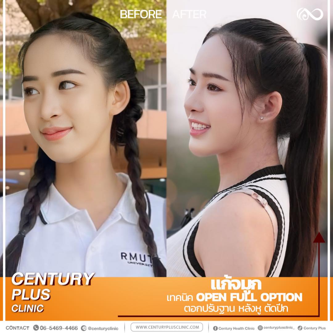 แก้จมูก #1190