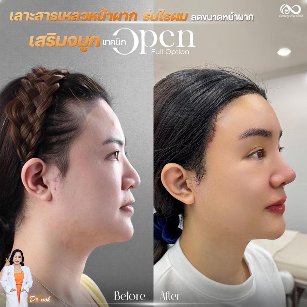 เสริมจมูก 1#1219