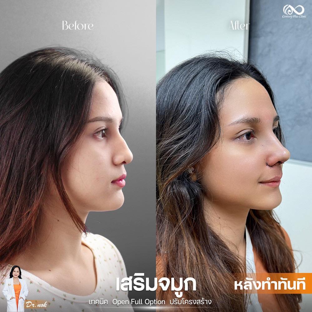 เสริมจมูก 1#1234