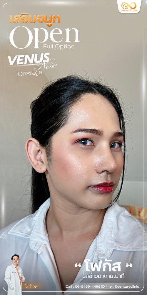 รีวิว เสริมจมูก #1198 , Century Clinic Thailand เสริมจมูก #1198