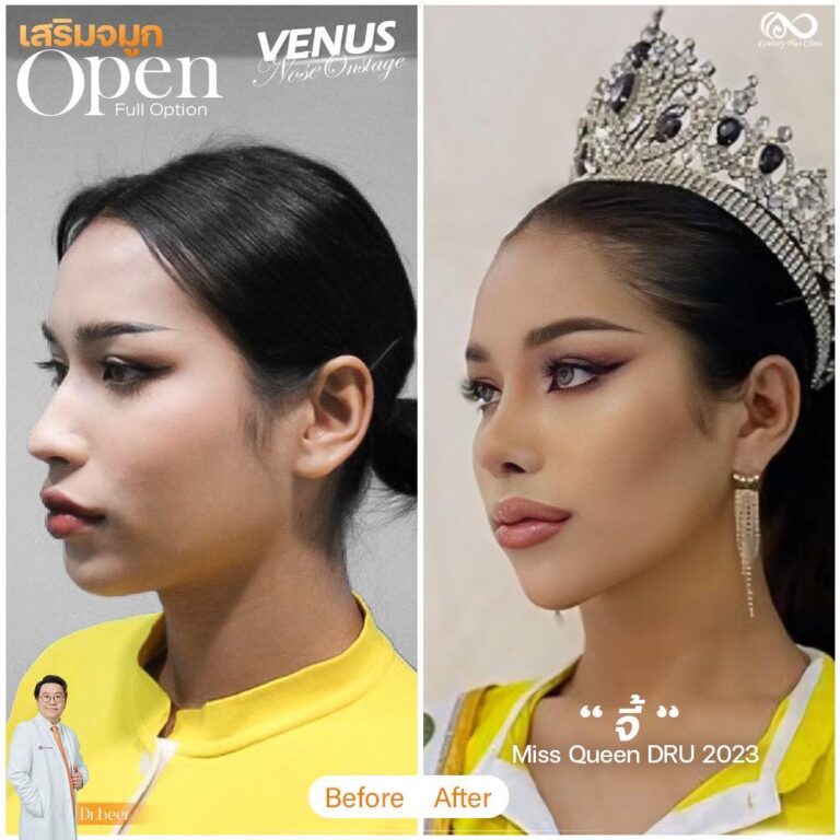เสริมจมูก #1199