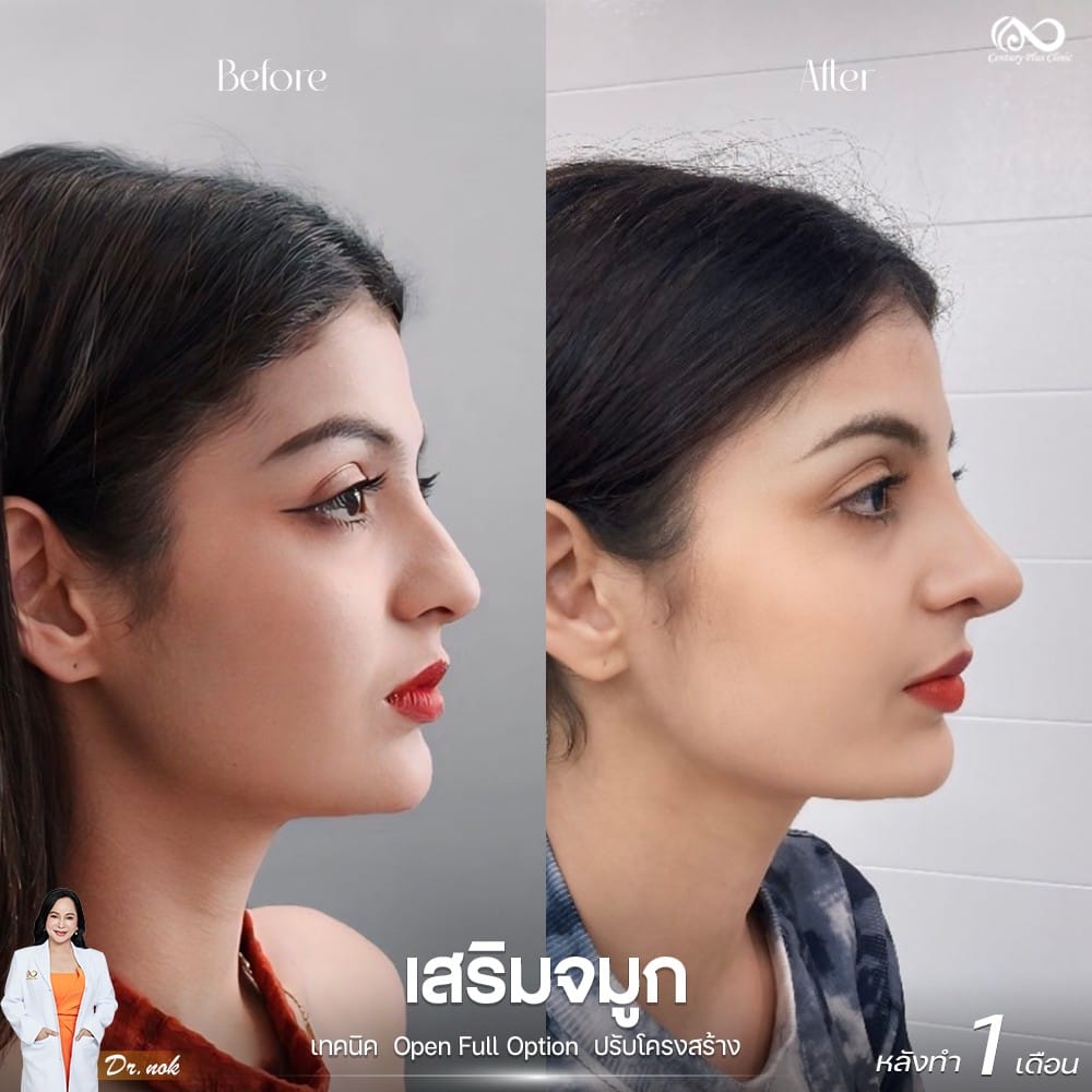 เสริมจมูก 2#1218