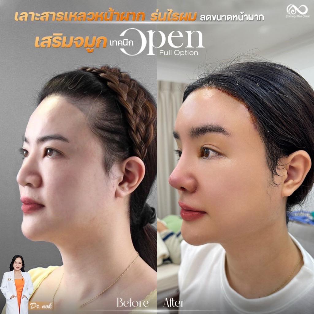 เสริมจมูก 2#1219