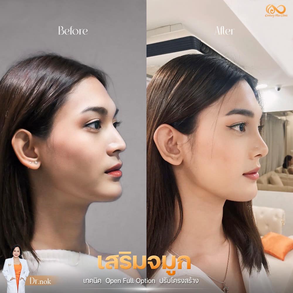 รีวิว เสริมจมูก #1227 , Century Clinic Thailand เสริมจมูก 2#1227