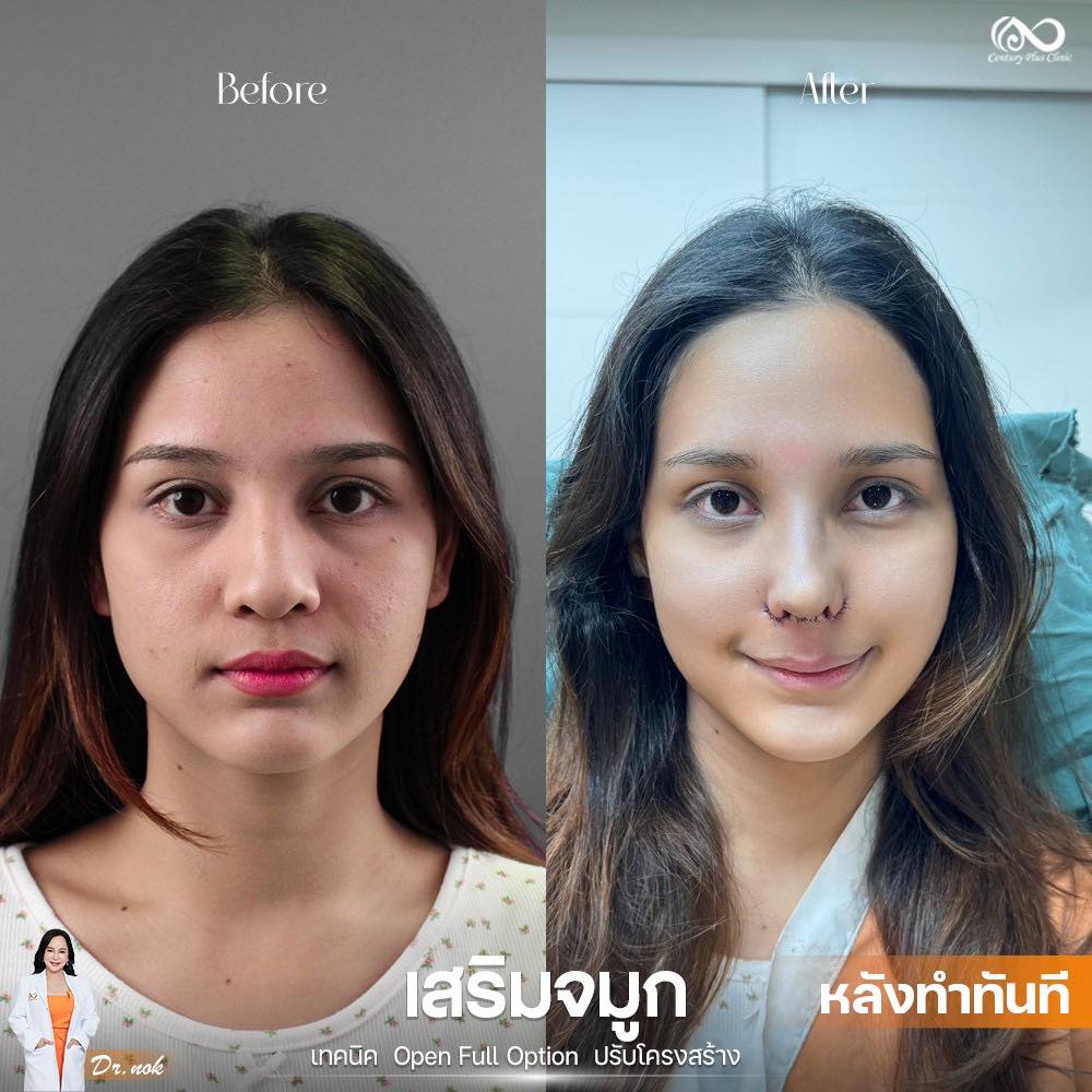 เสริมจมูก 2#1234