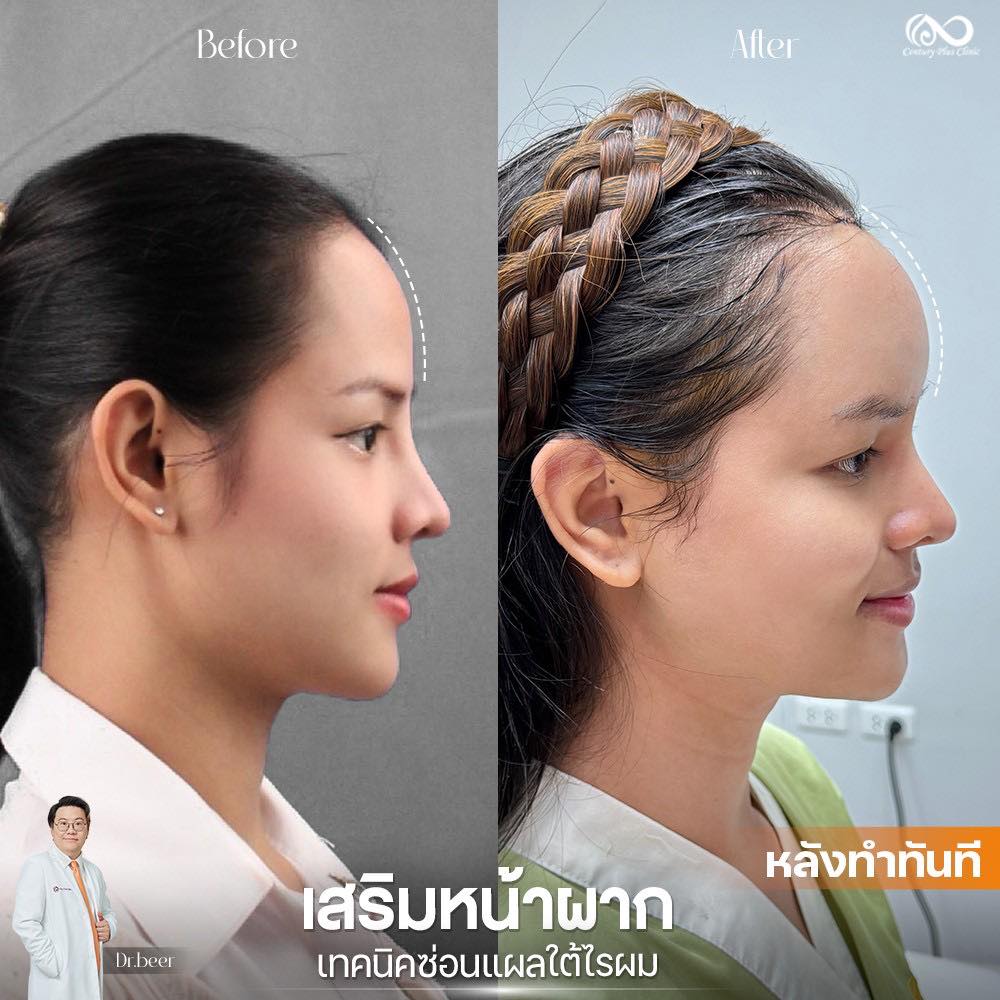 เสริมหน้าผาก 1#39