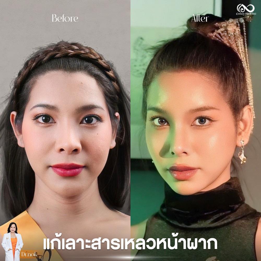 เสริมหน้าผาก 1#40