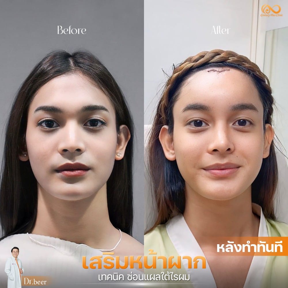 รีวิว เสริมหน้าผาก #41 , Century Clinic Thailand Century Clinic Thailand