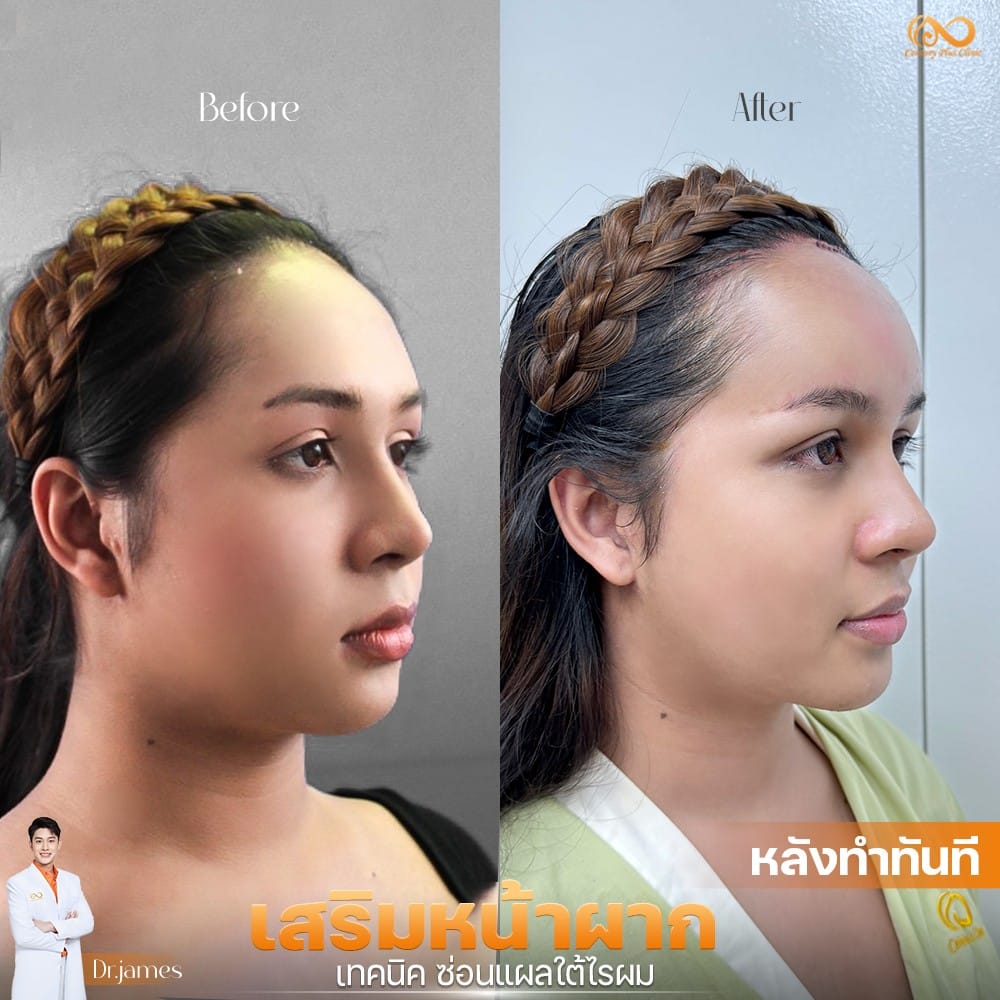 รีวิว เสริมหน้าผาก #42 , Century Clinic Thailand เสริมหน้าผาก 1#42