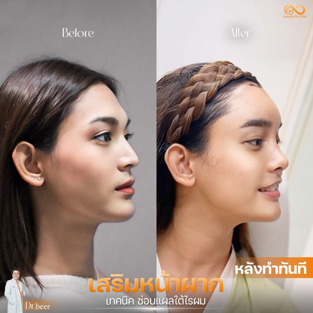 รีวิว เสริมหน้าผาก #41 , Century Clinic Thailand เสริมหน้าผาก 2#41