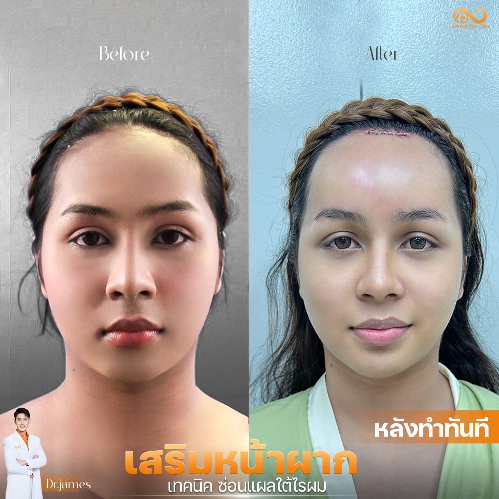 รีวิว เสริมหน้าผาก #42 , Century Clinic Thailand เสริมหน้าผาก2#42