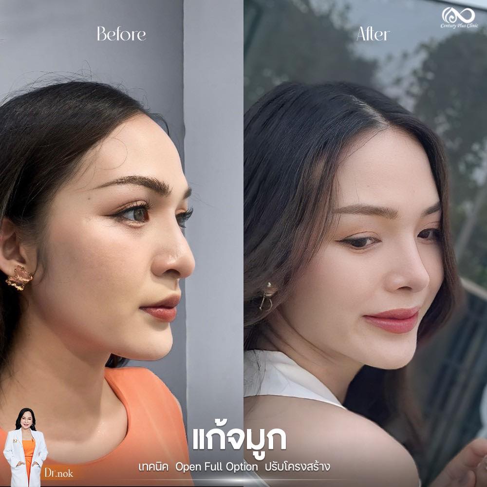 แก้จมูก 1#1212
