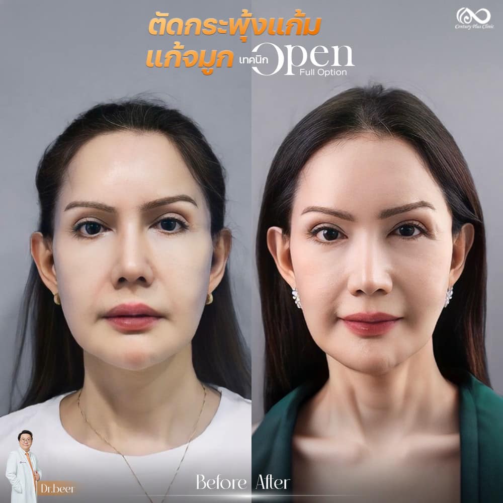 รีวิว แก้จมูก #1217 , Century Clinic Thailand แก้จมูก 1#1217