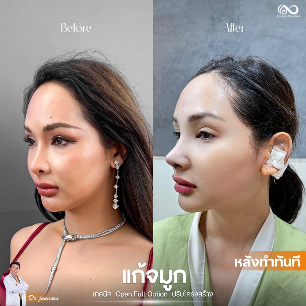 แก้จมูก 1#1223