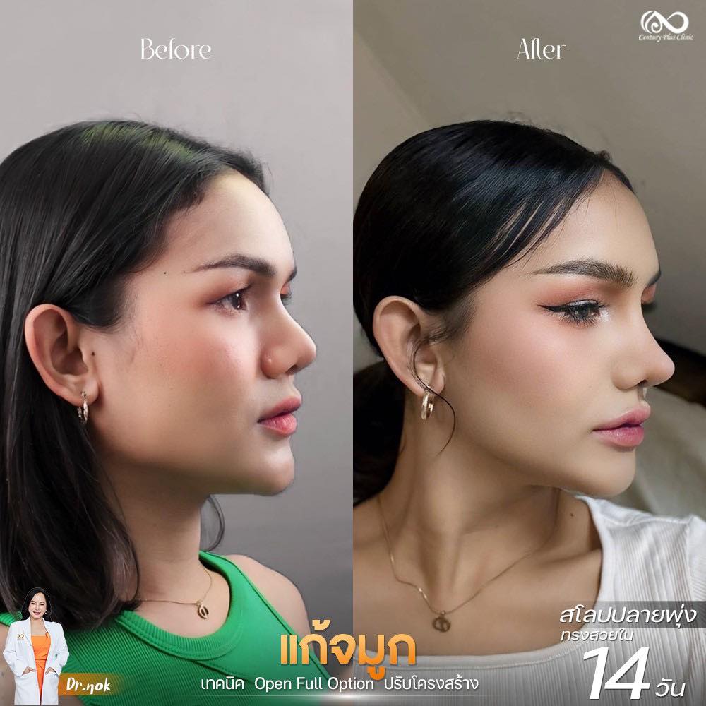 รีวิว แก้จมูก #1230 , Century Clinic Thailand แก้จมูก 1#1230