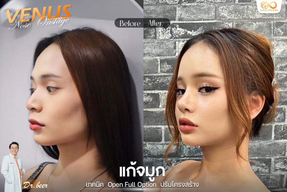 รีวิว แก้จมูก #1232 , Century Clinic Thailand แก้จมูก 1#1232