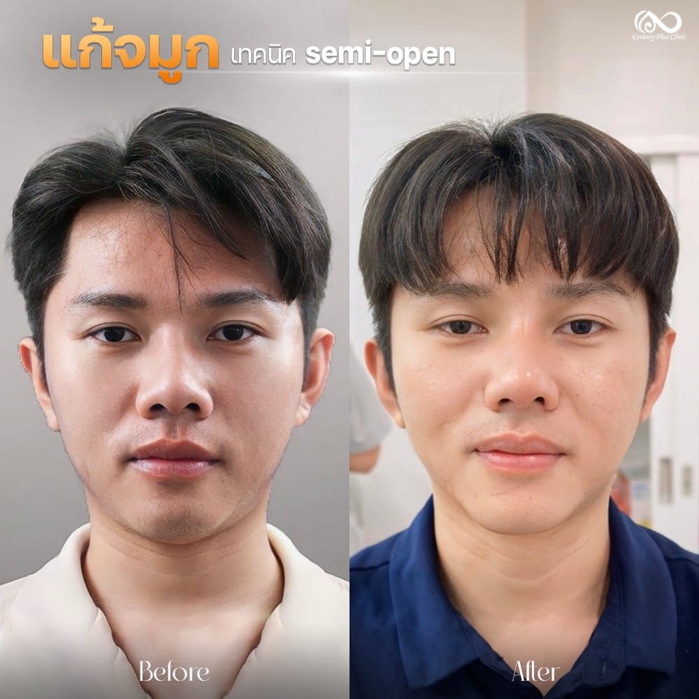 รีวิว แก้จมูก #1237 , Century Clinic Thailand แก้จมูก 1#1237