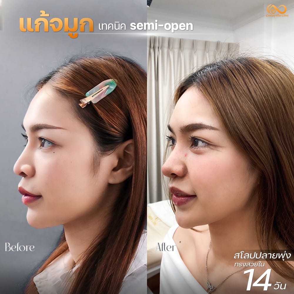 แก้จมูก 1#1240