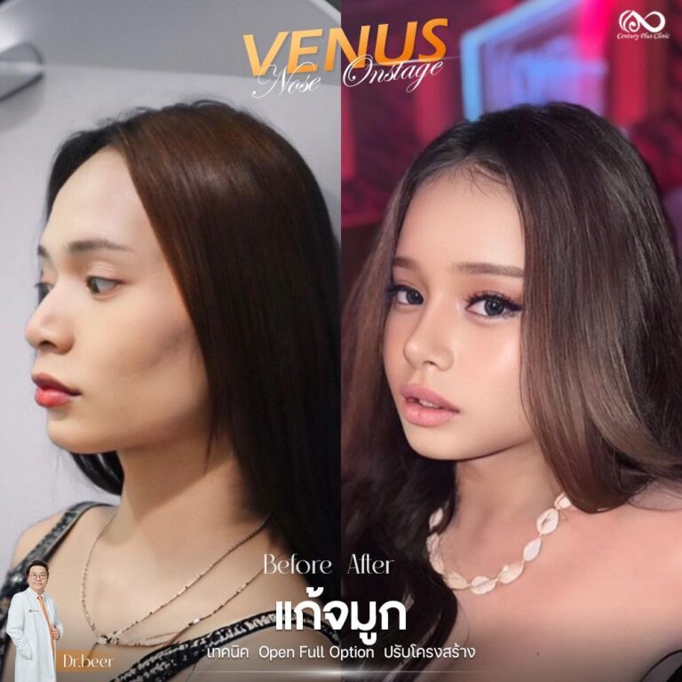 แก้จมูก #1215