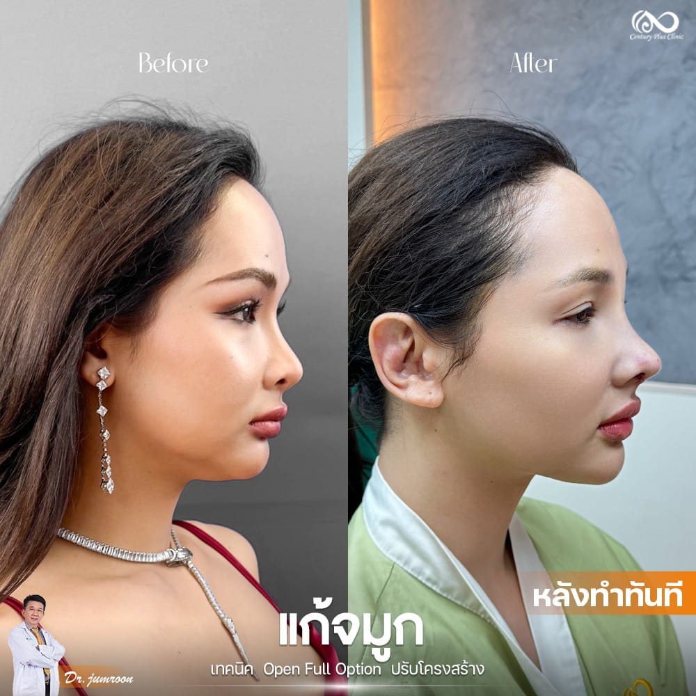 แก้จมูก 1#1223