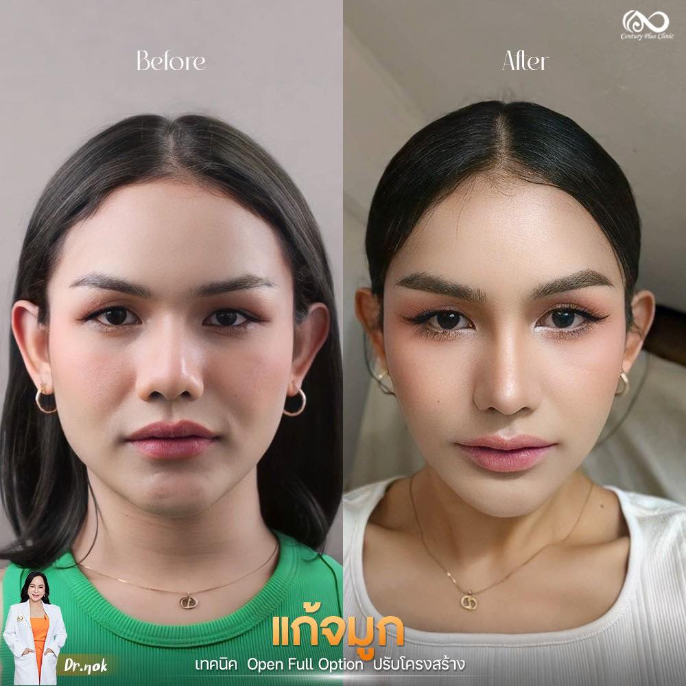 รีวิว แก้จมูก #1230 , Century Clinic Thailand แก้จมูก 2#1230