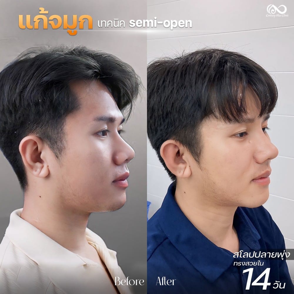 รีวิว แก้จมูก #1237 , Century Clinic Thailand แก้จมูก 2#1237