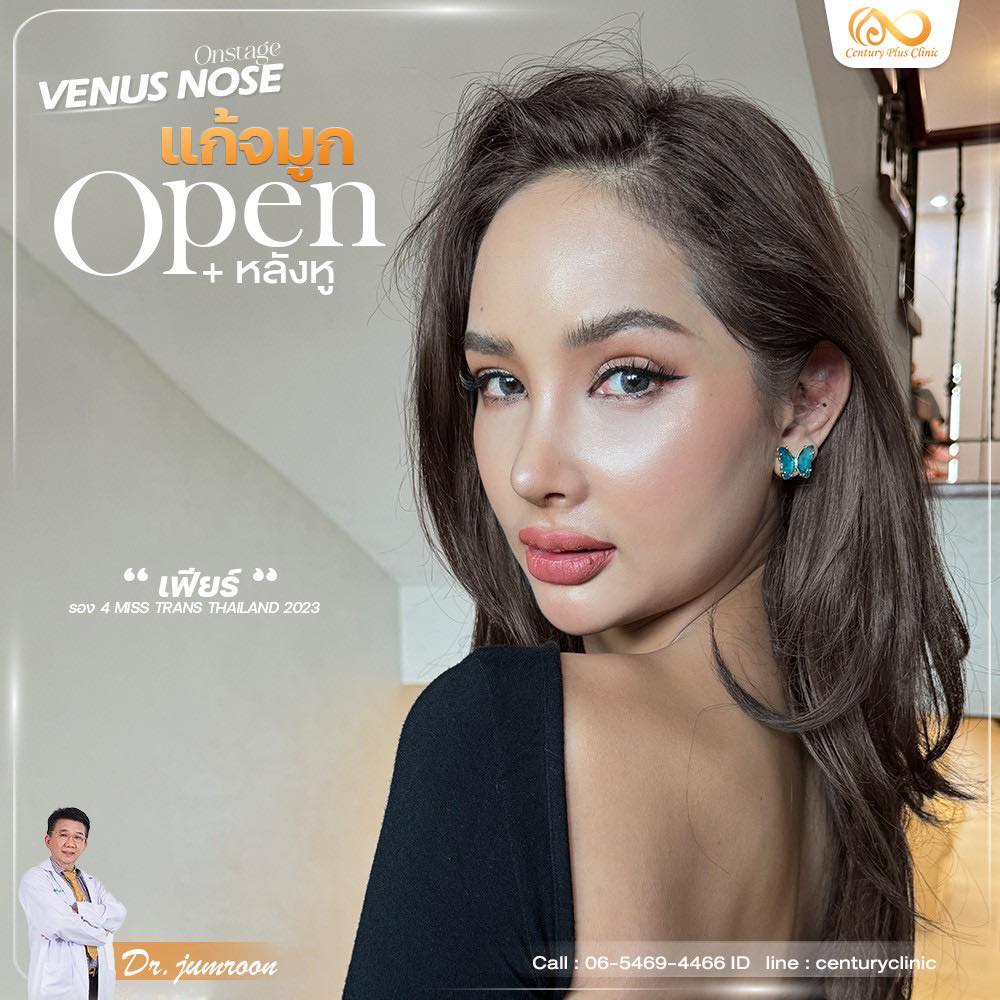 รีวิว แก้จมูก #1246 , Century Clinic Thailand แก้จมูก 2#1246