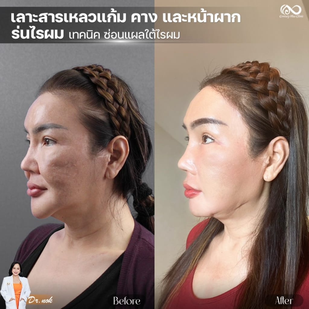 รีวิว เสริมหน้าผาก #45 , Century Clinic Thailand รีวิว หน้าผาก 1#45
