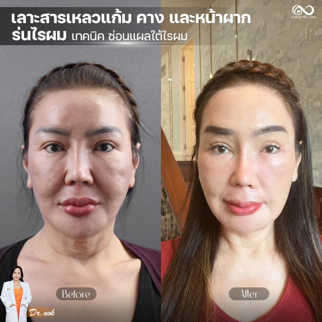 รีวิว เสริมหน้าผาก #45 , Century Clinic Thailand รีวิว หน้าผาก 2#45