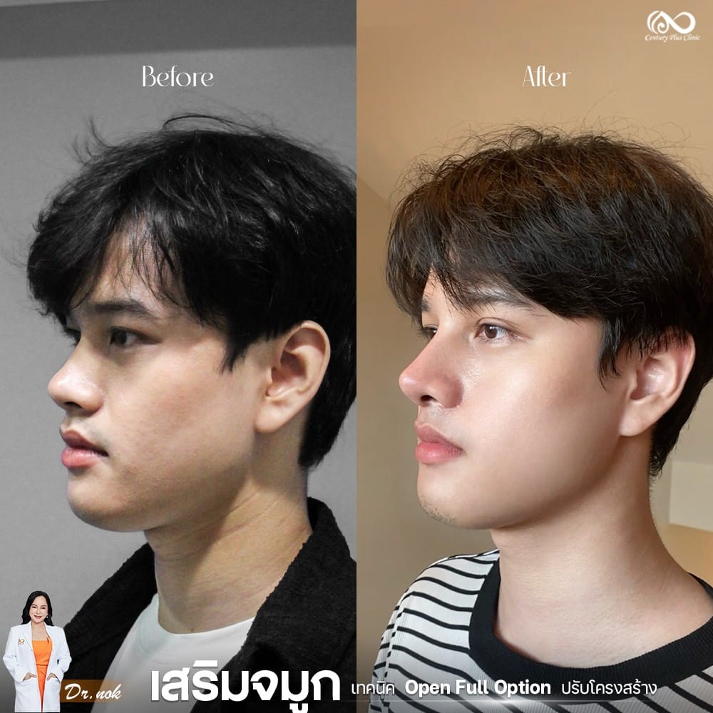 รีวิว เสริมจมูก #1256 , Century Clinic Thailand เสริมจมูก 1#1256