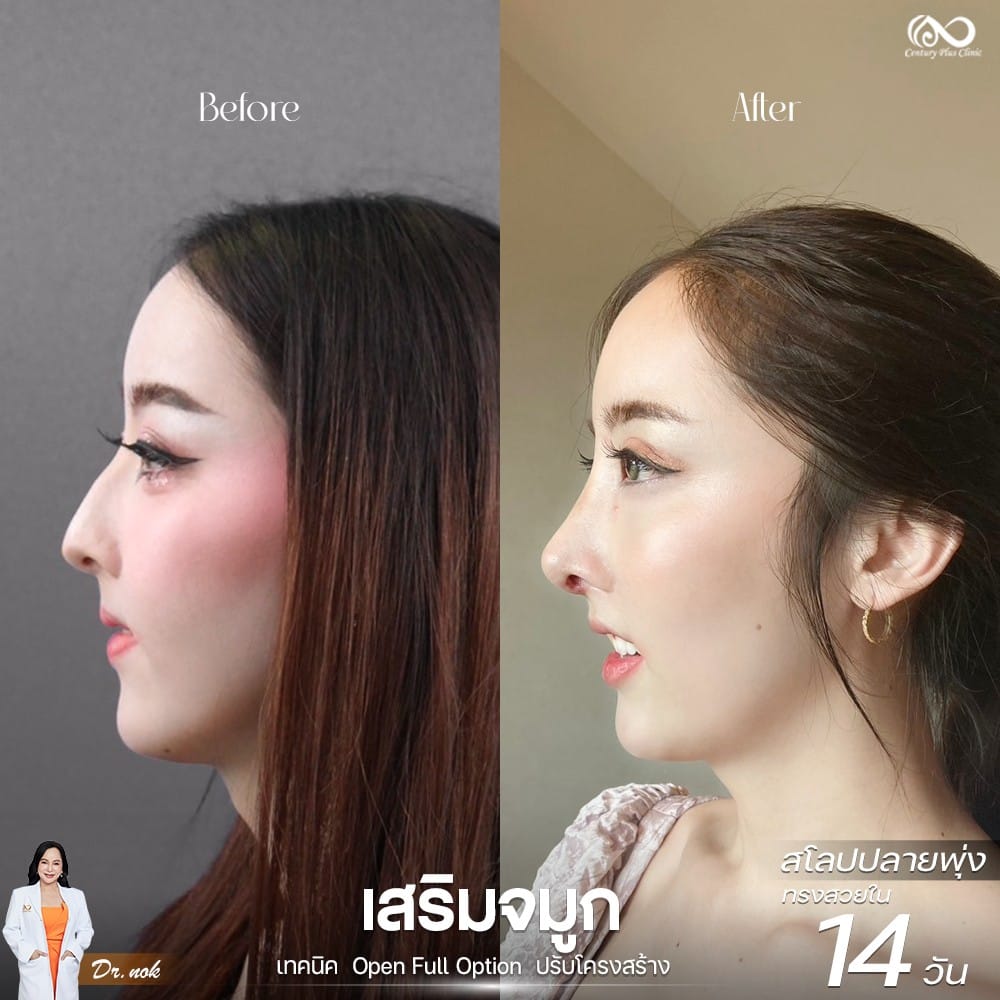 รีวิว เสริมจมูก #1262 , Century Clinic Thailand เสริมจมูก 1#1262