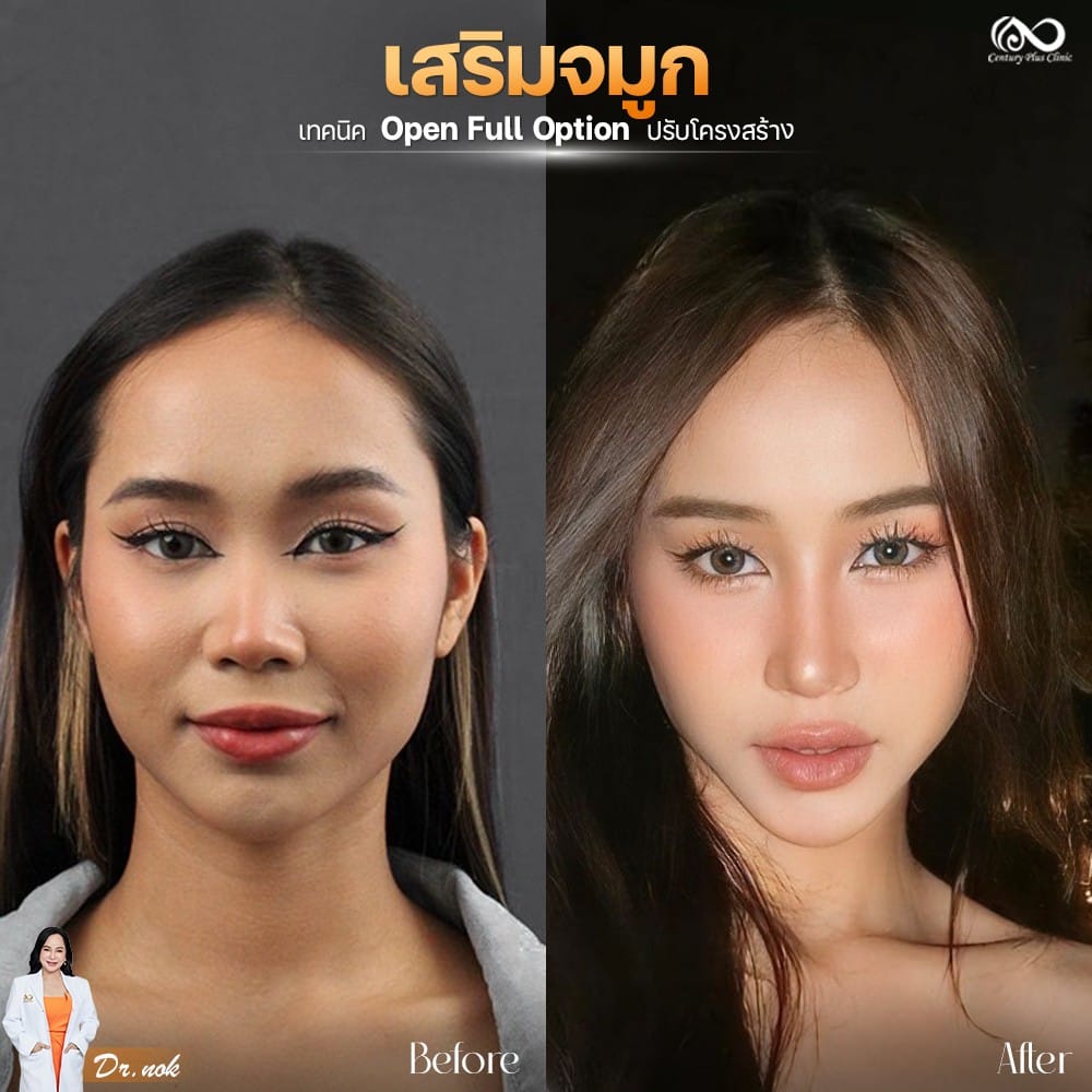 รีวิว เสริมจมูก #1279 , Century Clinic Thailand เสริมจมูก 1#1279