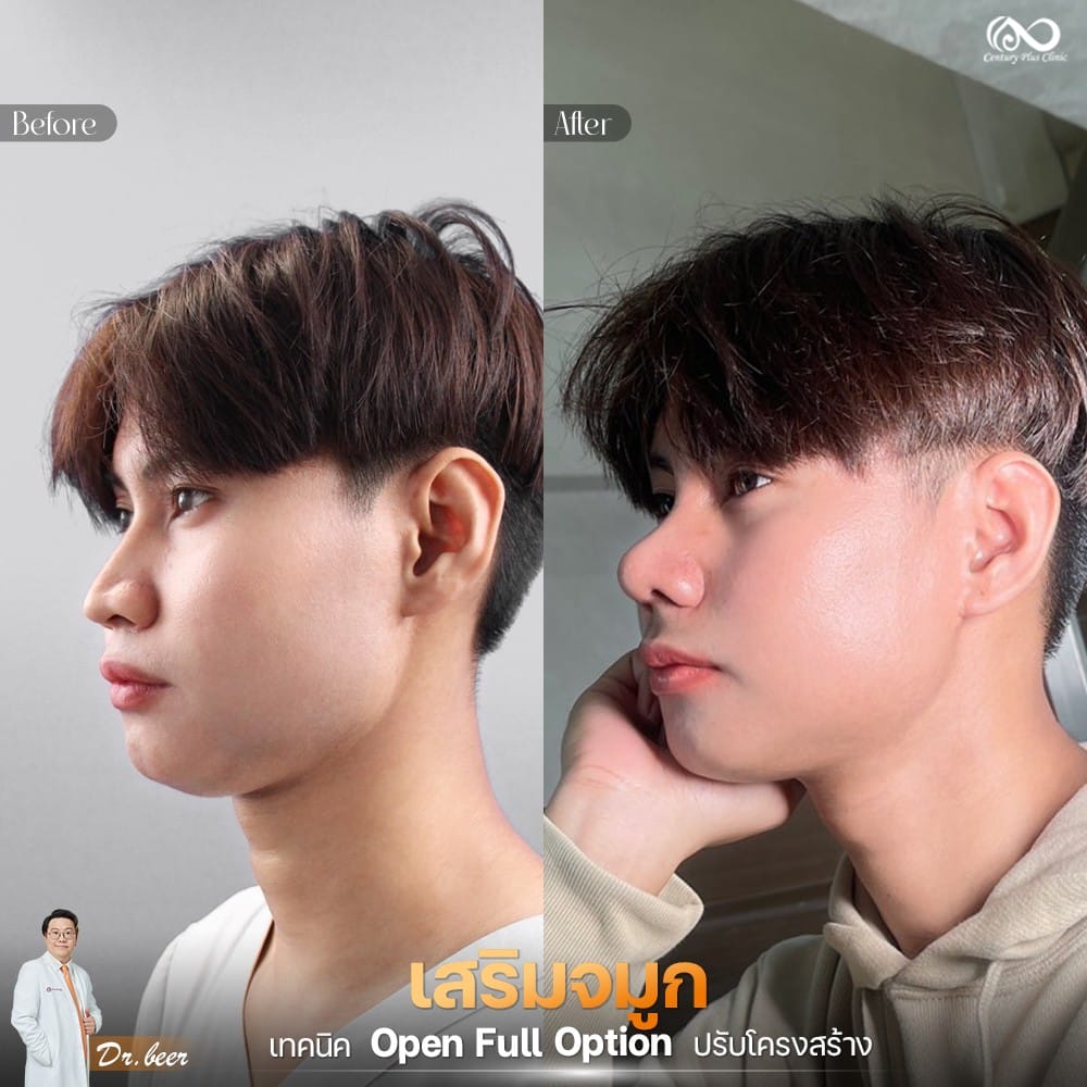เสริมจมูก 1#1286