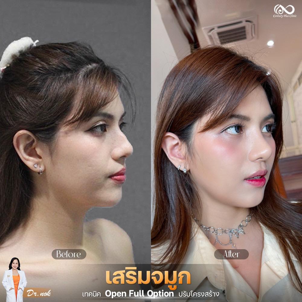 เสริมจมูก 1#1292
