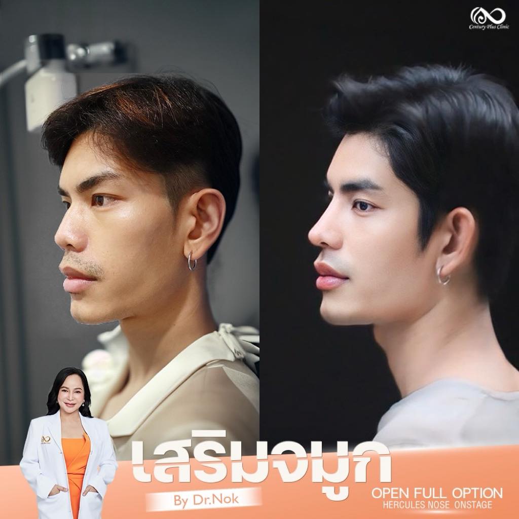 เสริมจมูก 1#1311