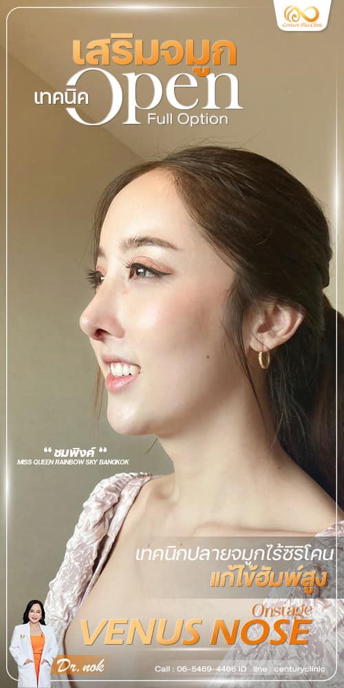 รีวิว เสริมจมูก #1262 , Century Clinic Thailand เสริมจมูก #1262