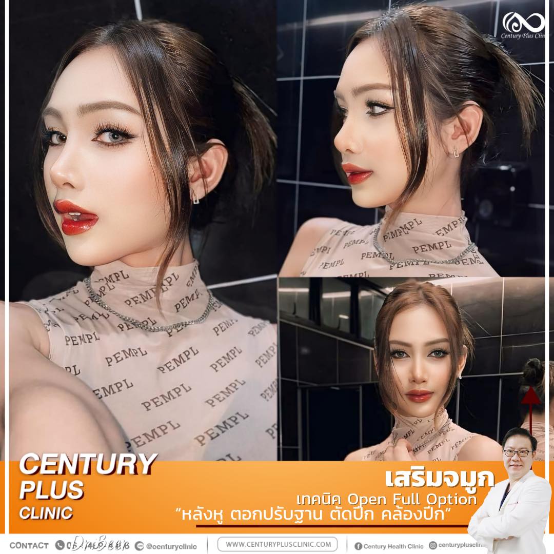 รีวิว เสริมจมูก #1276 , Century Clinic Thailand เสริมจมูก #1276