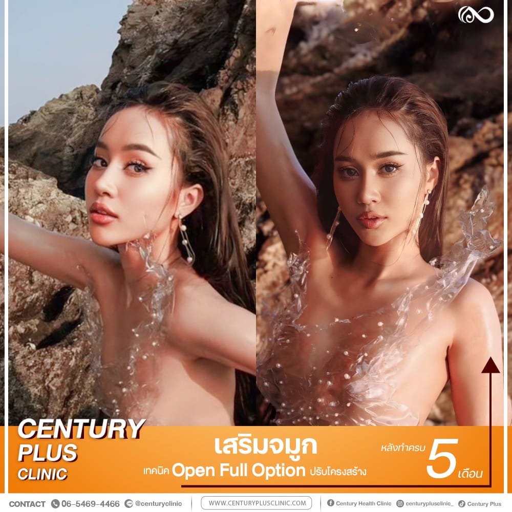 รีวิว เสริมจมูก #1306 , Century Clinic Thailand เสริมจมูก #1306
