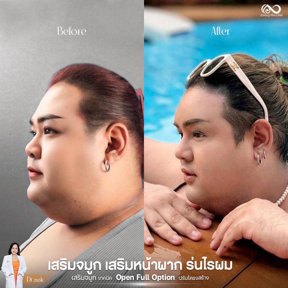 รีวิว เสริมจมูก #1252 , Century Clinic Thailand เสริมจมูก 2#1252