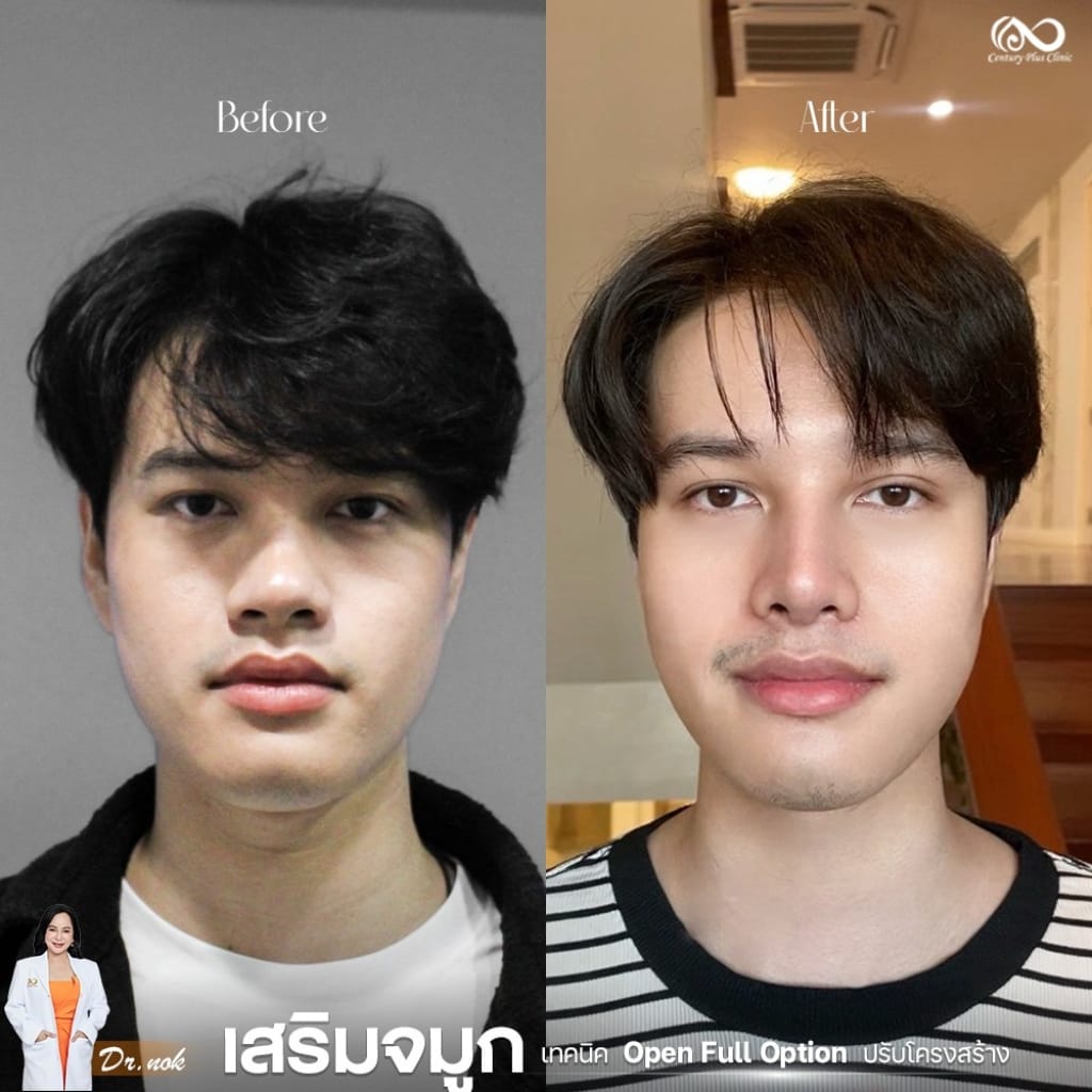 รีวิว เสริมจมูก #1256 , Century Clinic Thailand เสริมจมูก 2#1256