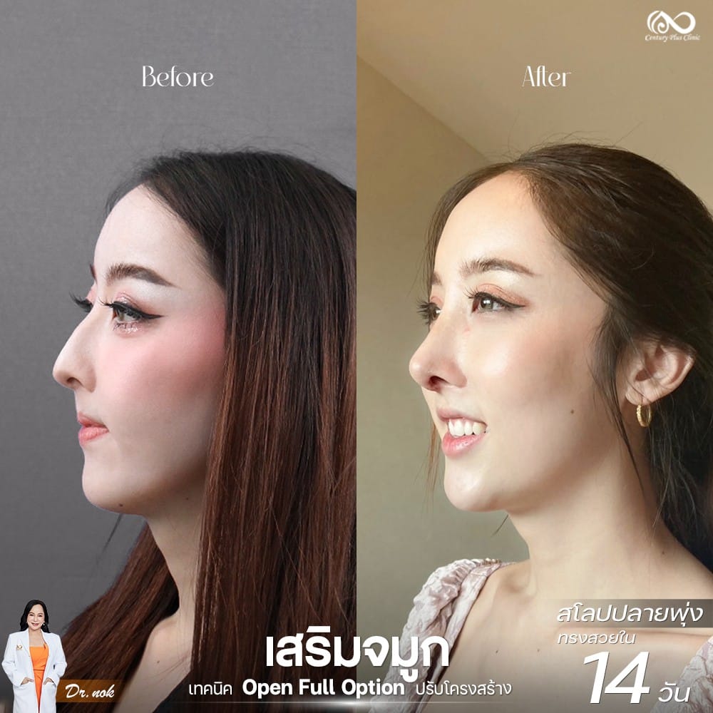 รีวิว เสริมจมูก #1262 , Century Clinic Thailand Century Clinic Thailand