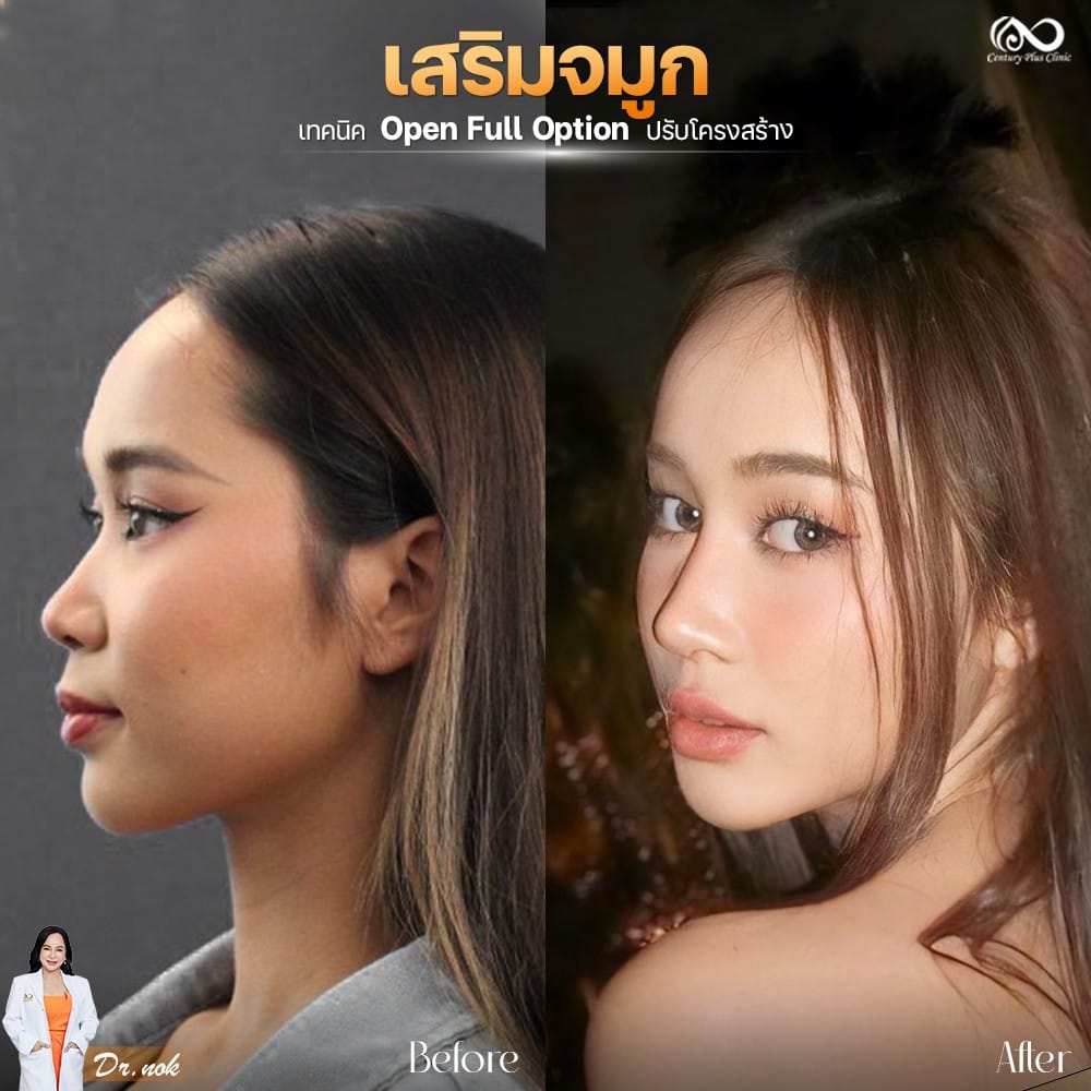 รีวิว เสริมจมูก #1279 , Century Clinic Thailand Century Clinic Thailand