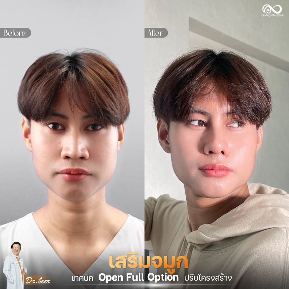 เสริมจมูก 2#1286