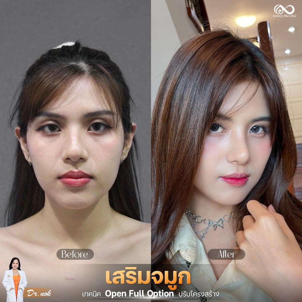 เสริมจมูก 2#1292