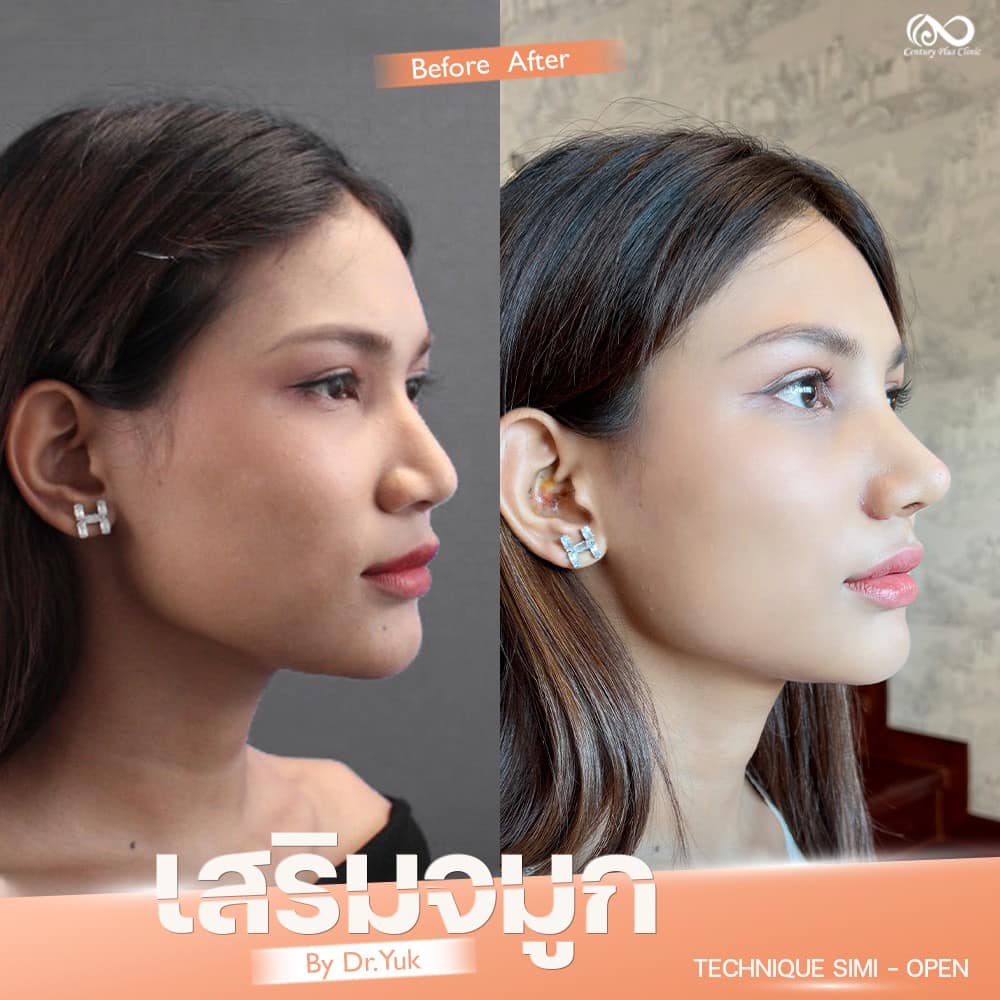 รีวิว เสริมจมูก #1300 , Century Clinic Thailand เสริมจมูก 2#1300