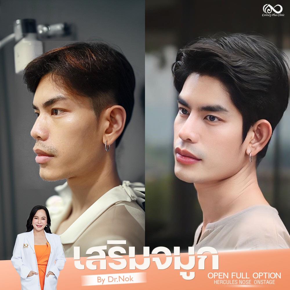 เสริมจมูก 2#1311