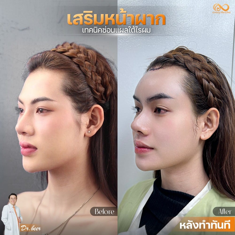 เสริมหน้าผาก 1#46