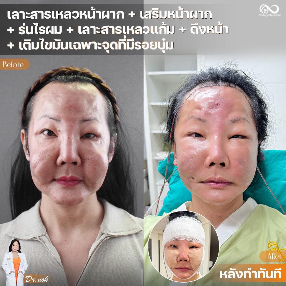 เสริมหน้าผาก #44
