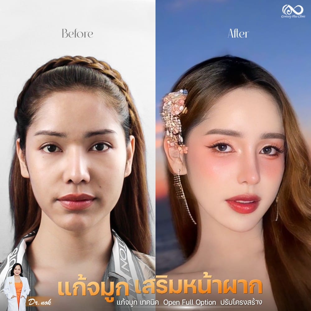 แก้จมูก 1#1258
