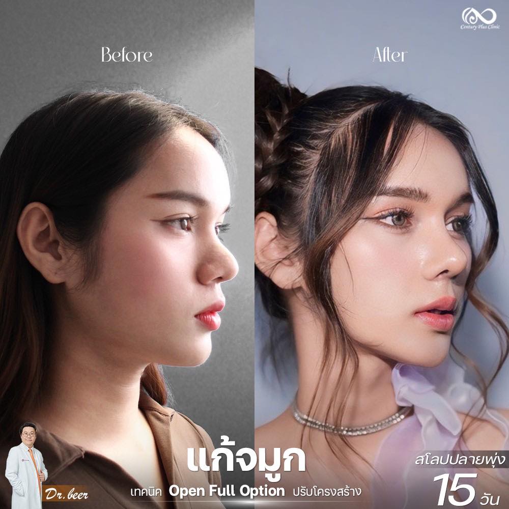 รีวิว แก้จมูก #1264 , Century Clinic Thailand แก้จมูก 1#1264